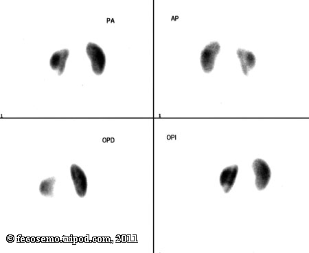 dmsa for chelation